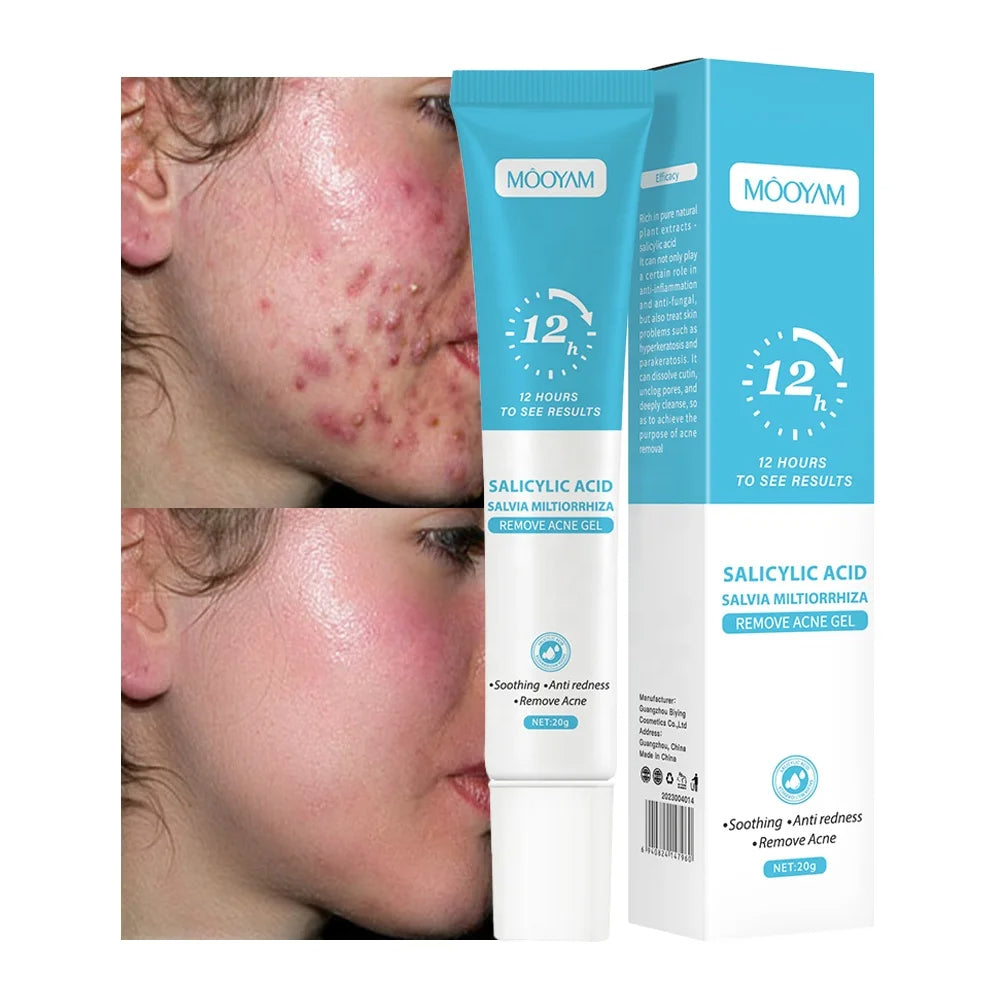 Gel Anti-Acné MOOYAM | Résultats visibles en 12h KAMOTEK