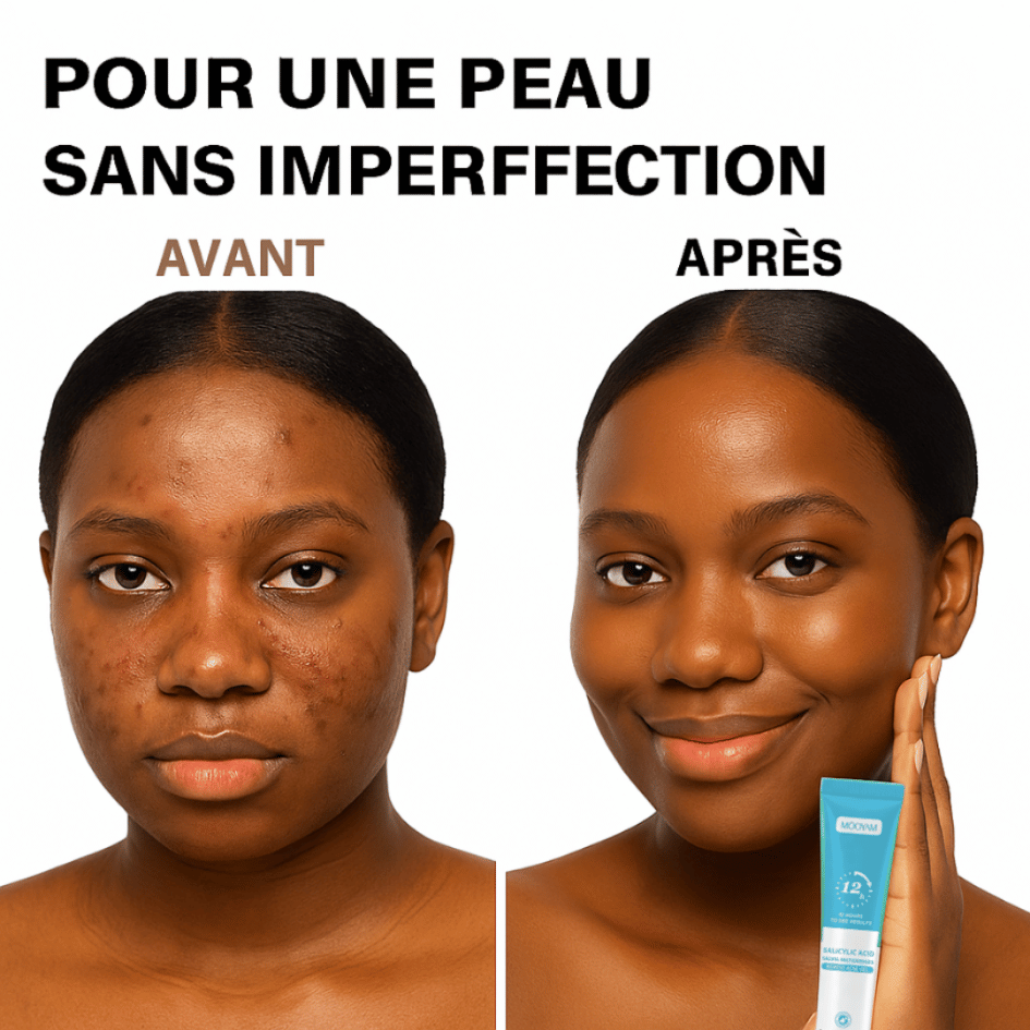 Gel Anti-Acné MOOYAM | Résultats visibles en 12h KAMOTEK